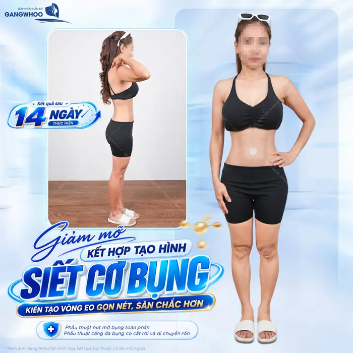 Kết quả sau 14 ngày giảm mỡ kết hợp tạo hình siết cơ bụng kiến tạo vòng eo đẹp thon và săn chắc