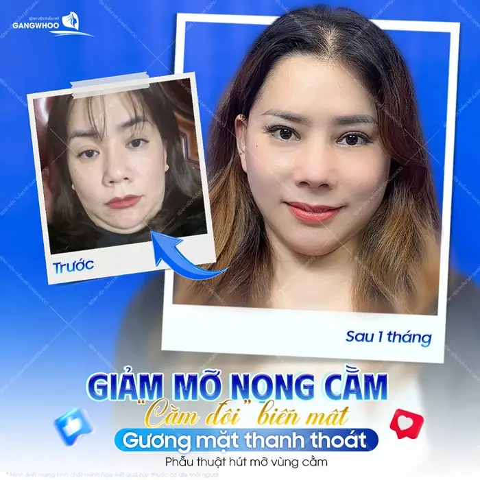 Giảm mỡ nọng cằm, cằm đôi biến mất gương mặt thanh thoát và rạng rỡ sau 1 tháng thực hiện