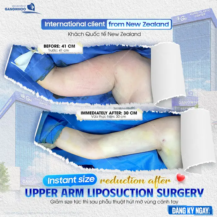 Giảm size tức thì sau phẫu thuật hút mỡ vùng cánh tay lựa chọn của khách hàng quốc tế đến từ New Zealand