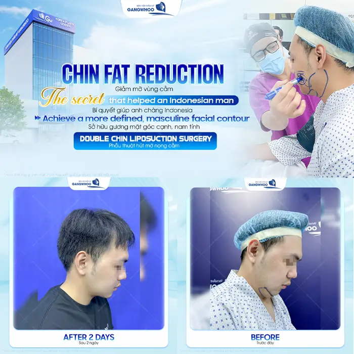 Giảm mỡ vùng cằm bí quyết giúp khách hàng đến từ Indonesia giúp gương mặt thon gọn và góc cạnh hơn thấy rõ