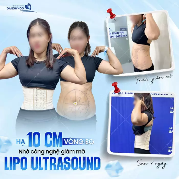 9 Lưu Ý Sau Khi Hút Mỡ Bụng Để Nhanh Chóng Hồi Phục 1 Tạm biệt 10cm vòng eo nhờ giảm mỡ công nghệ Lipo Ultrasound