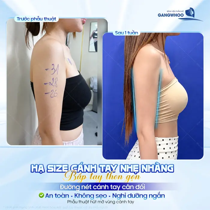 Khoe dáng tự tin không lộ ngấn mỡ sau 6 tháng giảm mỡ bụng công nghệ Lipo Ultrasound