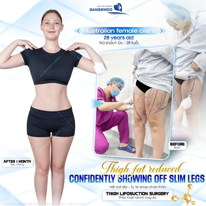 Giảm mỡ đùi, tự tin khoe đôi chân thon gọn sau 1 tháng đã đẹp thon gọn 