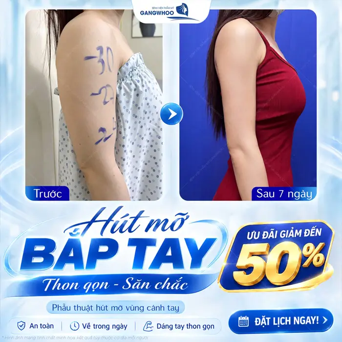 Hút Mỡ Bắp Tay Có Nguy Hiểm Không? Bác Sĩ Giải Đáp 3 Hút mỡ bắp tay sau 7 ngày đôi tay đã thon gọn, săn chắc và thêm hài hòa và cân đối với tỷ lệ cơ thể