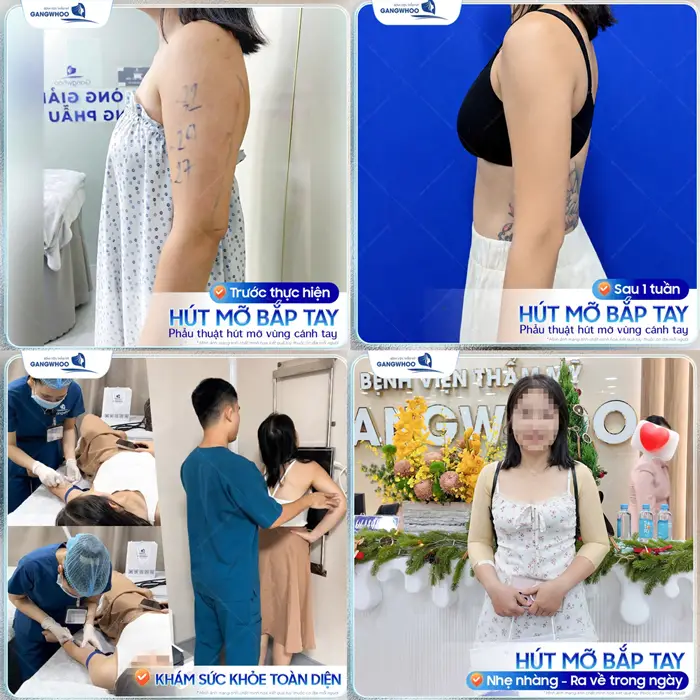 Hút Mỡ Bắp Tay Bị Lồi Lõm - Nguyên Nhân Và Cách Xử Lý Hiệu Quả 9 Hút mỡ bắp tay tại bệnh viện thẩm mỹ Gangwhoo tay đẹp thon nhanh lành và sớm hồi phục