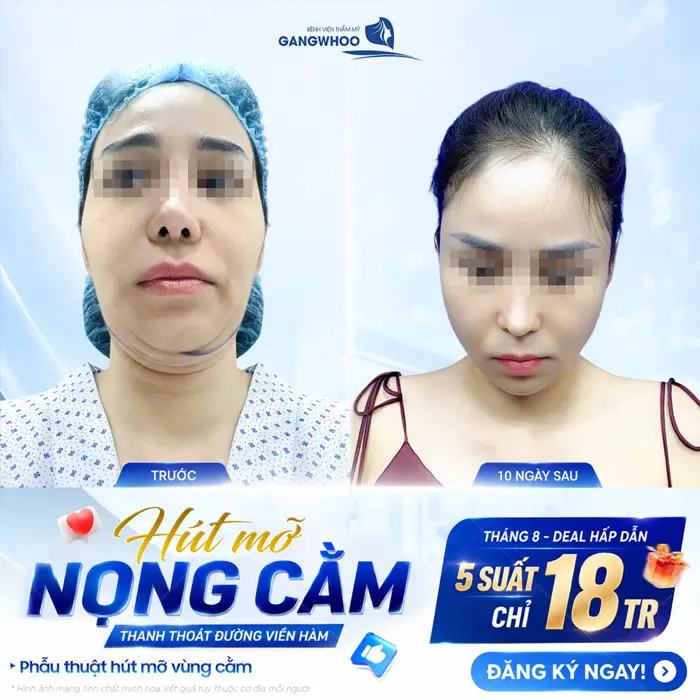 Hút Mỡ Nọng Cằm Ở Đâu Uy Tín? Top 9+ Địa Chỉ Tại TPHCM 9 Hút mỡ nọng cằm đường viền hàm thanh thoát tôn lên phẫu thuật hút mỡ vùng cằm