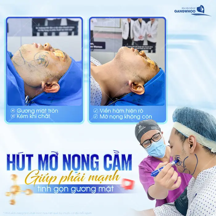 Hút mỡ nọng cằm giải pháp giúp phái mạnh tinh gọn đường nét cho gương mặt