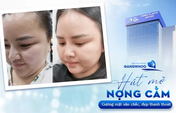 Hút Mỡ Nọng Cằm Có Nguy Hiểm Không? Bác Sĩ Giải Đáp 2 Hút Mỡ Nọng Cằm Có Nguy Hiểm Không? Bác Sĩ Giải Đáp