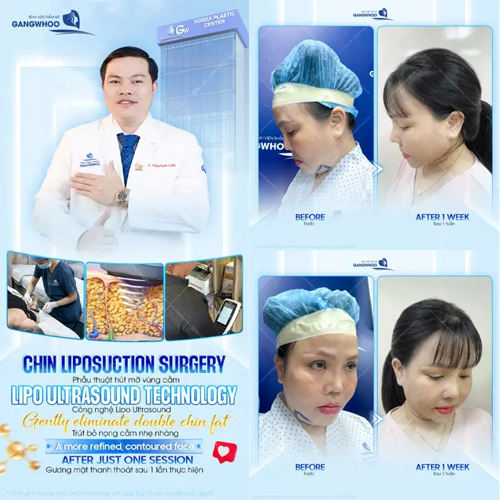 Phẫu thuật hút mỡ nọng cằm Lipo Ultrasound cằm thon gọn, đẹp hài hòa gương mặt thêm thanh tú sau thực hiện 