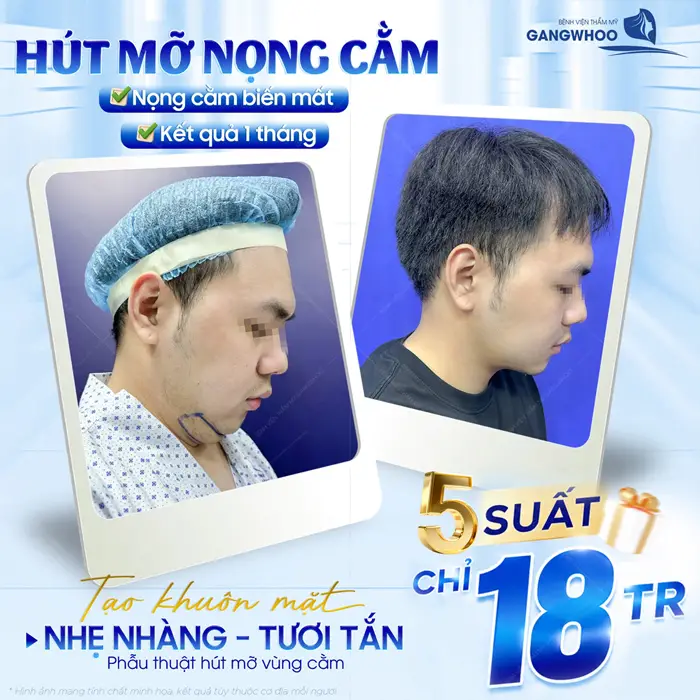 Hút Mỡ Nọng Cằm Có Nguy Hiểm Không? Bác Sĩ Giải Đáp 1 Hút mỡ nọng cằm tạo khuôn mặt nhẹ nhàng, tươi tắn sau 1 tháng đã cải thiện diện mạo với đường nét đẹp thon gọn hơn