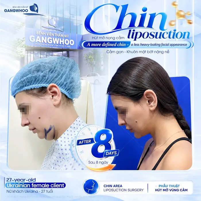 Hút mỡ nọng cằm khuôn mặt bớt nặng nề cải thiện đường viền hàm thêm thon gọn và hài hòa