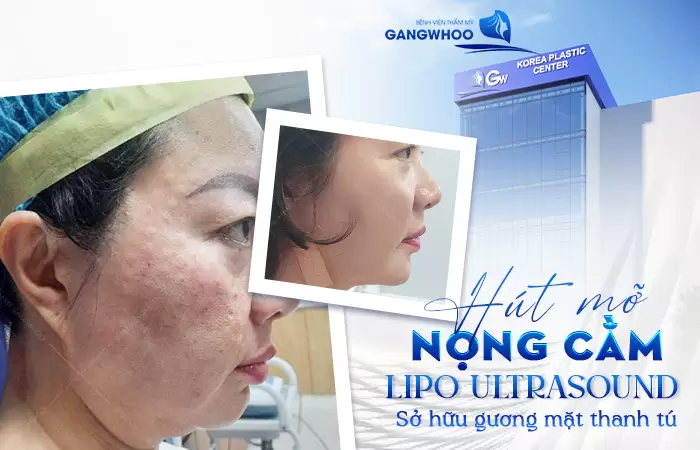 Hút Mỡ Nọng Cằm Ở Đâu Uy Tín? Top 6+ Địa Chỉ Bạn Nên Biết 8 Hút Mỡ Nọng Cằm Ở Đâu Uy Tín? Top 6+ Địa Chỉ Bạn Nên Biết