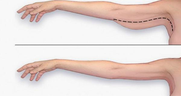 How Long Does Arm Liposuction Become Beautiful?