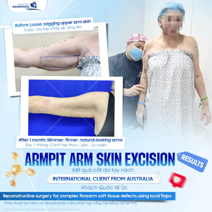 Kết quả phẫu thuật hút mỡ cánh tay sau 1 tháng tái khám đôi tay đã thon gọn đều đẹp và cải thiện thấy rõ