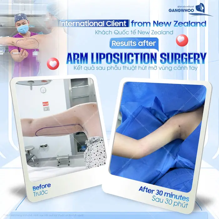 Hút Mỡ Bắp Tay Có Nguy Hiểm Không? Bác Sĩ Giải Đáp 1 Kết quả sau phẫu thuật hút mỡ vùng cánh tay của khách hàng quốc tế đến từ New Zealand