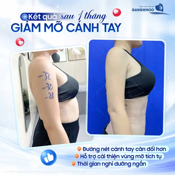 Kết quả sau 1 tháng giảm mỡ cánh tay đường nét cánh tay cân đối và hài hòa hơn