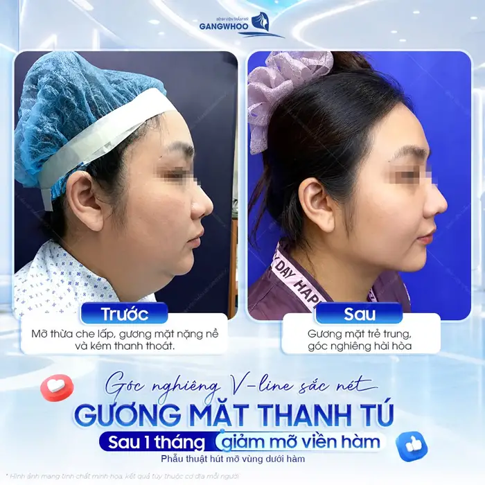 Hút Mỡ Nọng Cằm Ở Đâu Uy Tín? Top 9+ Địa Chỉ Tại TPHCM 1 Góc nghiêng V Line sắc nét gương mặt thanh tú sau 1 tháng giảm mỡ viền cằm