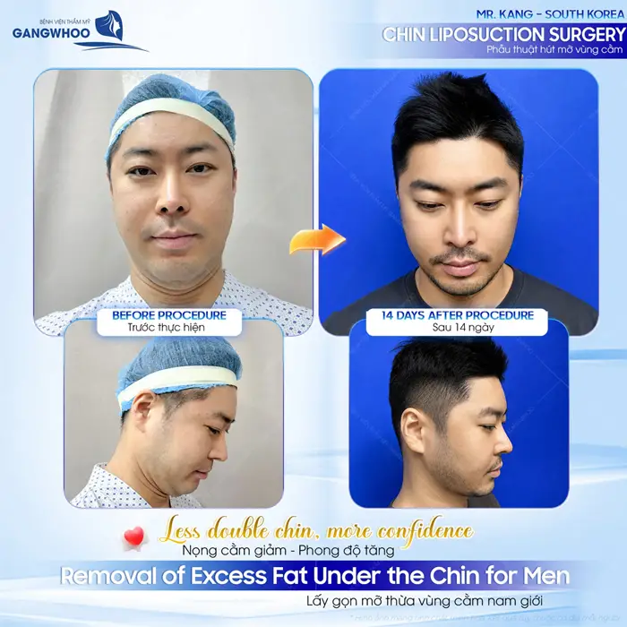 Xóa nọng cằm cho gương mặt thêm thon gọn và hài hòa tôn nét đẹp cho tổng thể diện mạo khuôn mặt