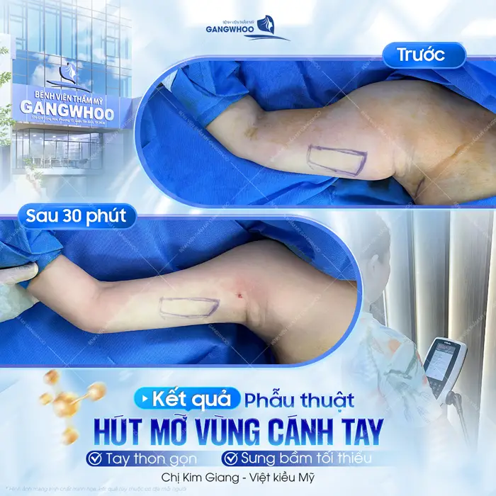 Kết quả sau phẫu thuật hút mỡ vùng cánh tay tự tin với đôi tay thon gọn, giảm sưng bầm tối thiểu