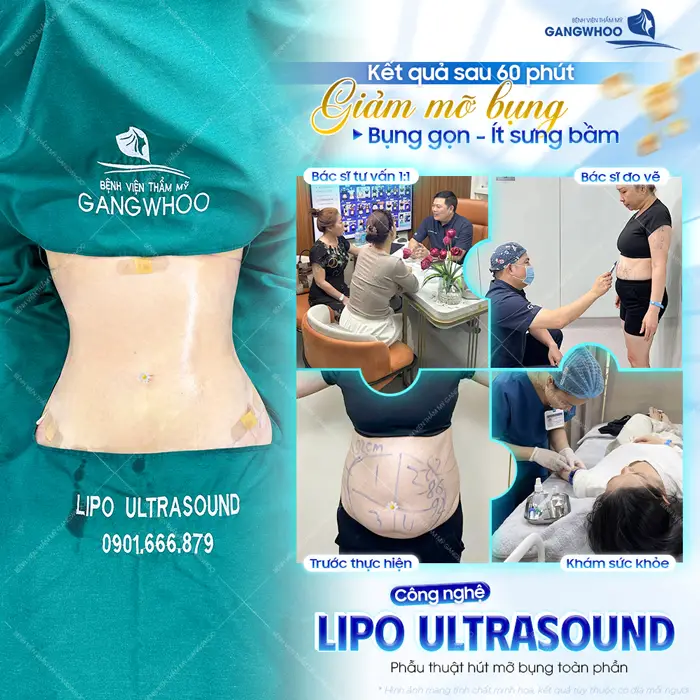 Kết quả sau 60 phút giảm mỡ bụng với quy trình an toàn, chuẩn hóa eo thon đẹp gọn nhẹ nhàng không còn sưng đau