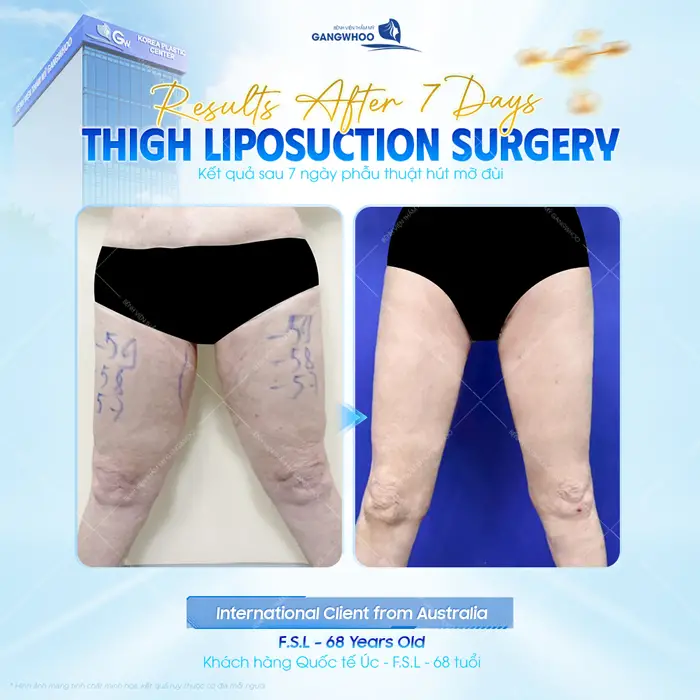 Kết quả sau 7 ngày hút mỡ đùi chân thon gọn hơn cho khách hàng đến từ Úc