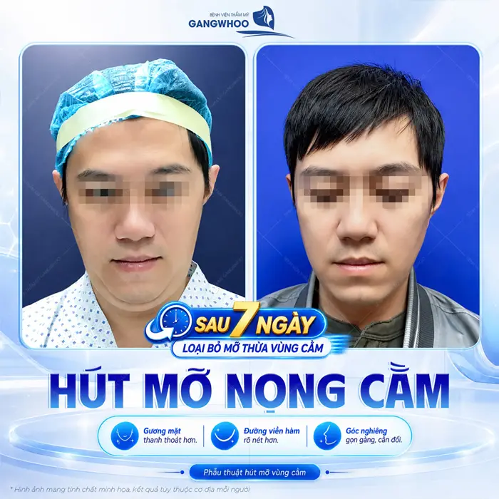 Kết quả sau 7 ngày loại bỏ mỡ nọng cằm khôi phục diện mạo gương mặt với đường viền hàm thanh thoát, tự nhiên 