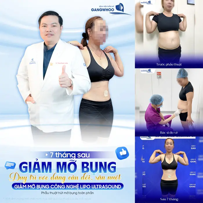 Giảm mỡ bụng công nghệ Lipo Ultrasound màn lột xác đẹp xuất sắc sau 7 tháng đã hoàn toàn thay đổi 