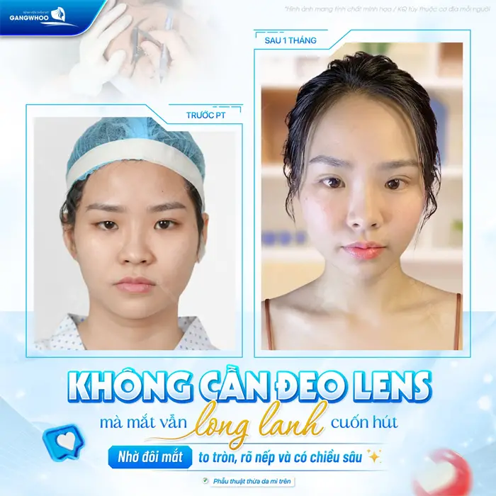 Top 8+ Bác Sĩ Cắt Mí Mắt Đẹp, Nổi Tiếng Tại TPHCM 2 Nhờ đôi mắt to tròn, rõ nếp và có cheièu sâu nhưng ánh mắt vẫn cuốn hút và đầy rạng rỡ
