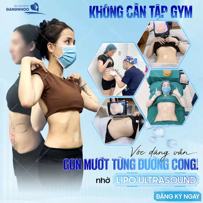 Không cần phả tập gym vẫn sở hữu vóc dáng cực nuột nà sau giảm mỡ (Lipo Ultrasound)