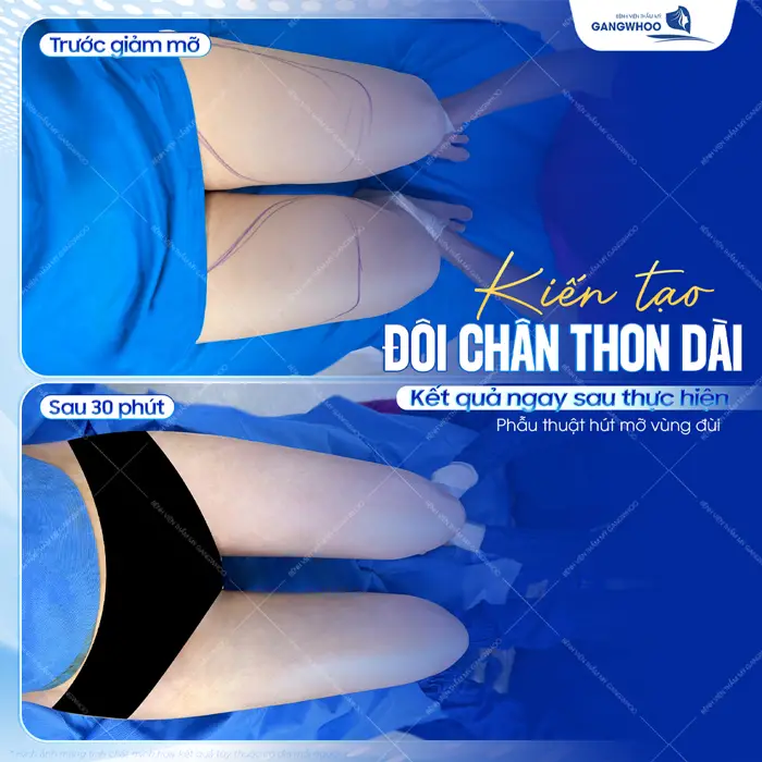 Kiến tạo đôi chân thon dài kết quả ngay sau thực hiện 