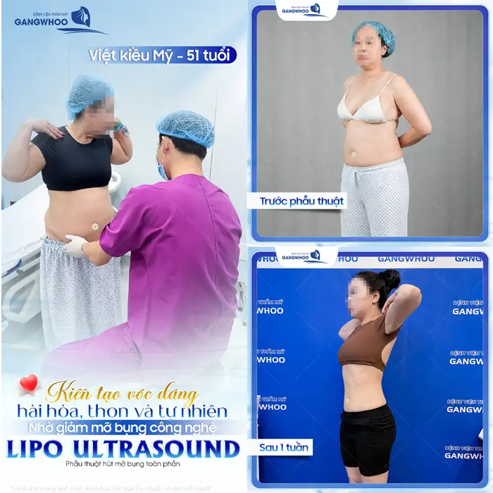 Kiến tạo vóc dáng hài hòa, thon gọn và tự nhiên nhờ giảm mỡ bụng công nghệ Lipo Ultrasound hiện đại