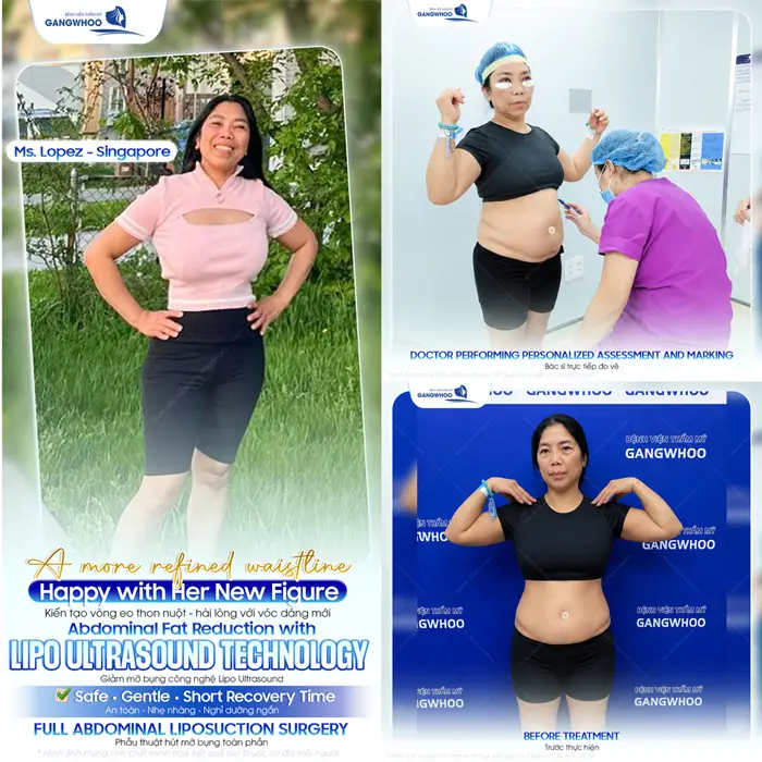 Kiến tạo vòng eo thon nuột khách hàng quốc tế hài lòng với kết quả sau giảm mỡ công nghệ Lipo Ultrasound