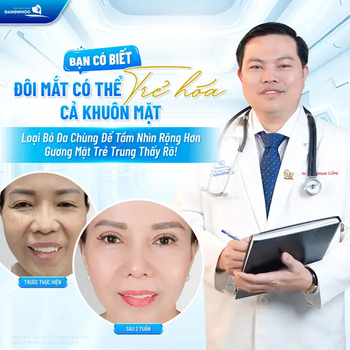 Đôi mắt trẻ hóa cả diện mạo trẻ lại sau cắt loại bỏ da chùng bọng mắt dưới