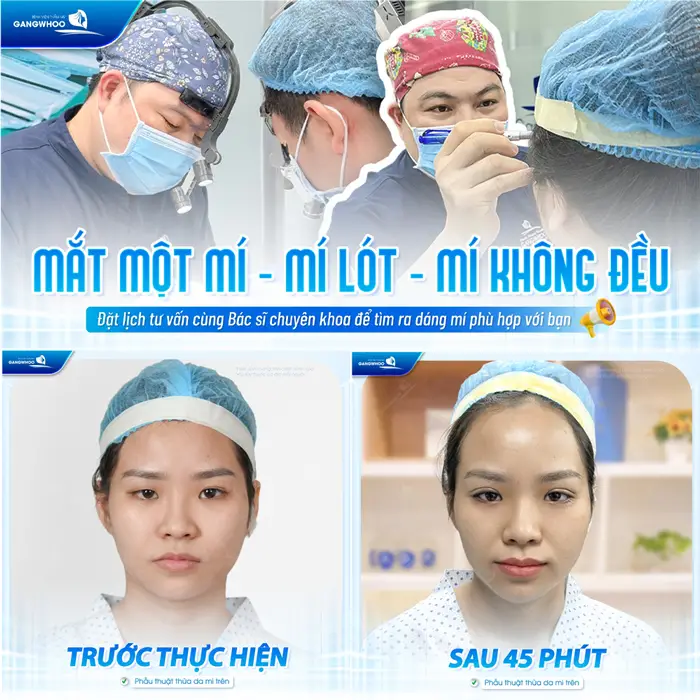 Mắt 1 mí, mí lót, mí không đều sau 45 phút cũng đã sở hữu đôi mắt 2 mí đều đẹp, hài hòa và cân đối 