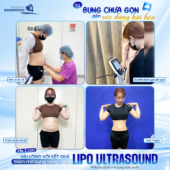 Từ bụng chưa gọn đến vóc dáng hài hòa mẹ bỉm 2 con hài lòng về kết quả giảm mỡ Lipo Ultrasound 