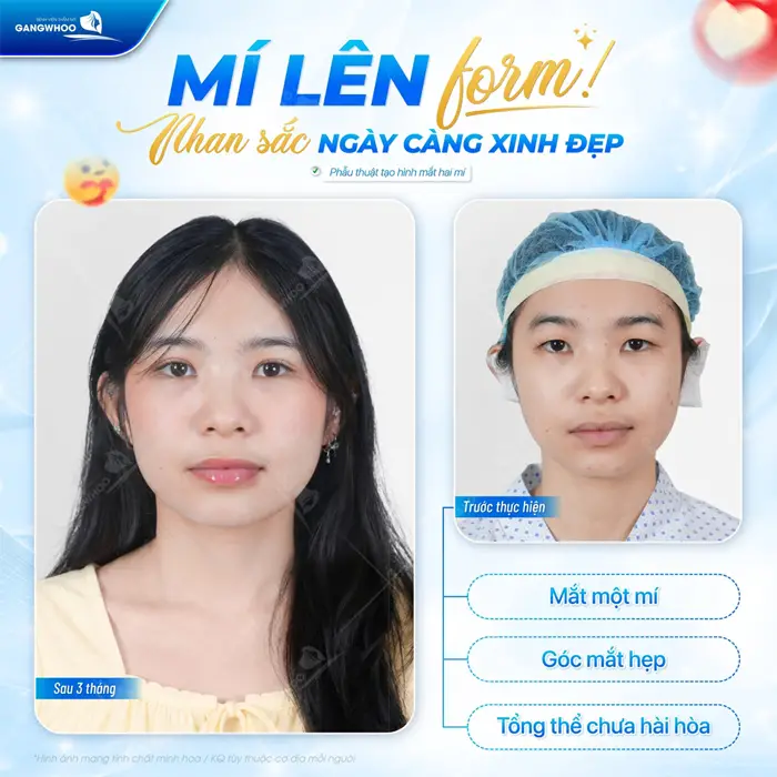 Top 8+ Bác Sĩ Cắt Mí Mắt Đẹp, Nổi Tiếng Tại TPHCM 3 Mí đẹp lên form nhan sắc ngày càng xinh đẹp và thăng hạng hơn thấy rõ