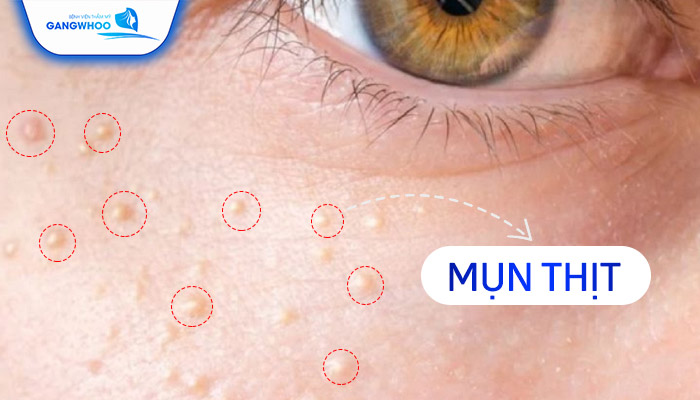 Điều Trị Mụn Thịt Tận Gốc Với Công Nghệ Hàn Quốc 9 Điều Trị Mụn Thịt
