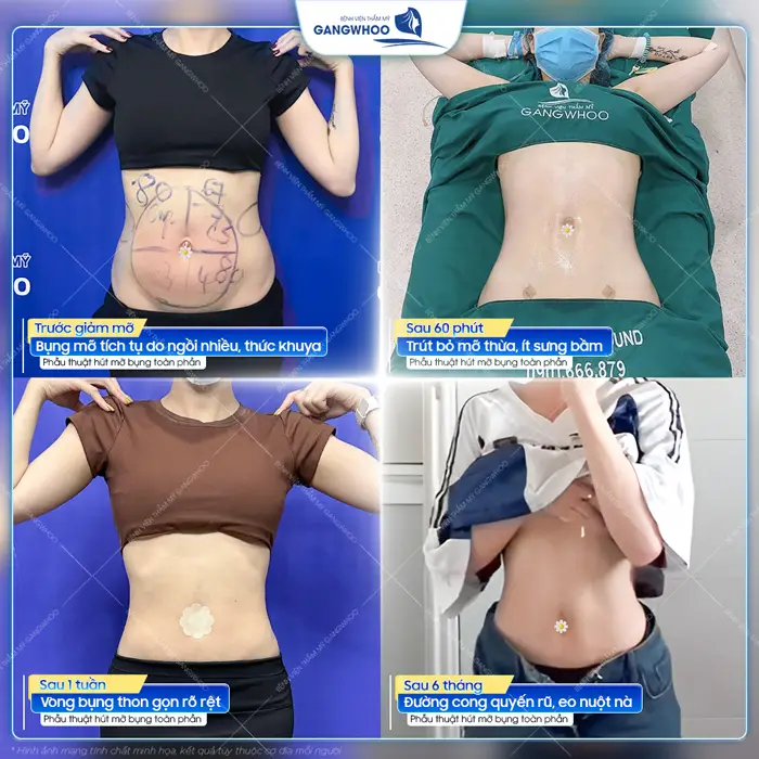 Nhìn lại thành quả sau 6 tháng phẫu thuật hút mỡ bụng toàn phần đường cong quyến rũ, tự tin khoe eo thon nuột nà