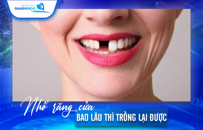 Nhổ Răng Cửa Bao Lâu Thì Trồng Lại Được? Bác Sĩ Giải Đáp 2 Nhổ Răng Cửa Bao Lâu Thì Trồng Lại Được