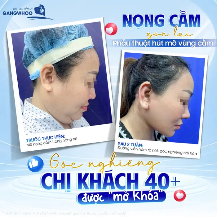 Hút Mỡ Nọng Cằm Có Nguy Hiểm Không? Bác Sĩ Giải Đáp 3 Nọng cằm gọn lại cho chị khách 40 tuổi chỉ sau 2 tuần gương mặt đã thon thả hơn hẳn