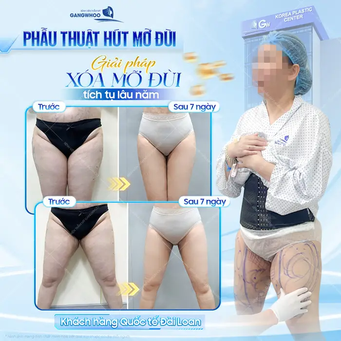 Phẫu thuật hút mỡ đùi giải pháp xóa mỡ đùi tích tụ lâu năm hiệu quả sau 7 ngày can thiệp