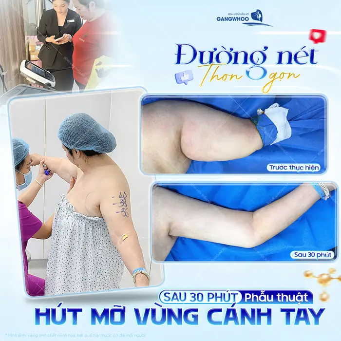 30 phút phẫu thuật hút mỡ vùng cánh tay đường nét đã thon gọn và khác biệt thấy rõ