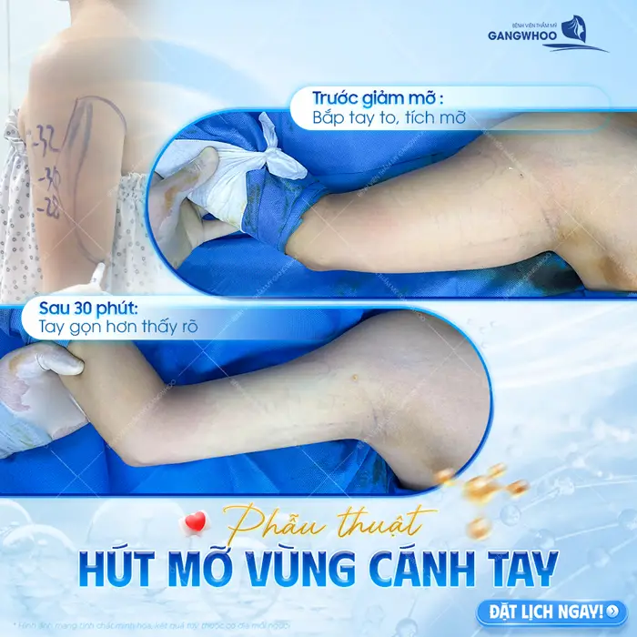 Phẫu thuật hút mỡ vùng cánh tay tạm biệt bắp tay to, tích mỡ thừa chỉ sau 30 phút thực hiện