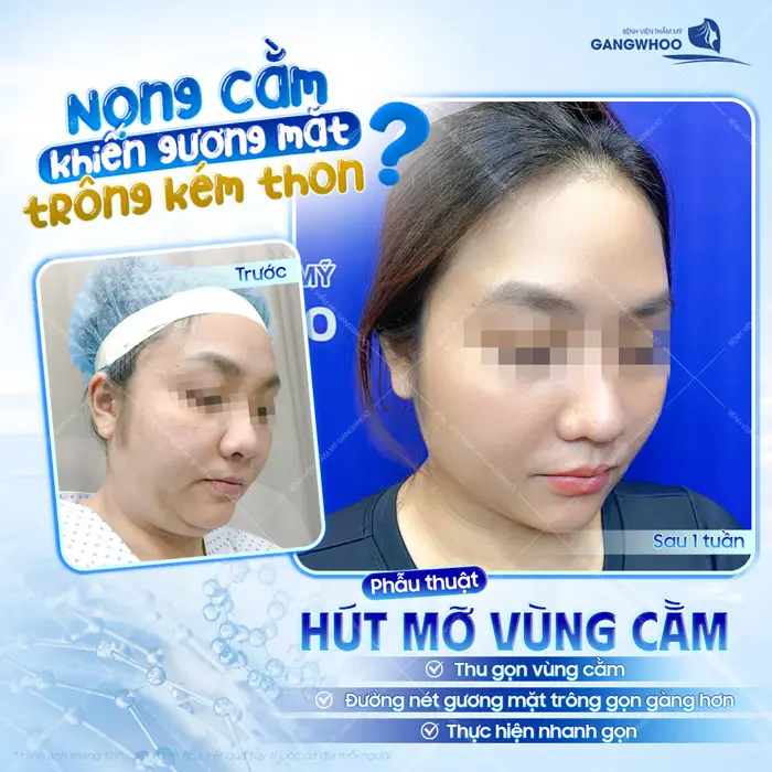 Phẫu thuật hút mỡ vùng cằm sau 1 tuần tái khám cằm thọn gon đẹp sắc nét thấy rõ