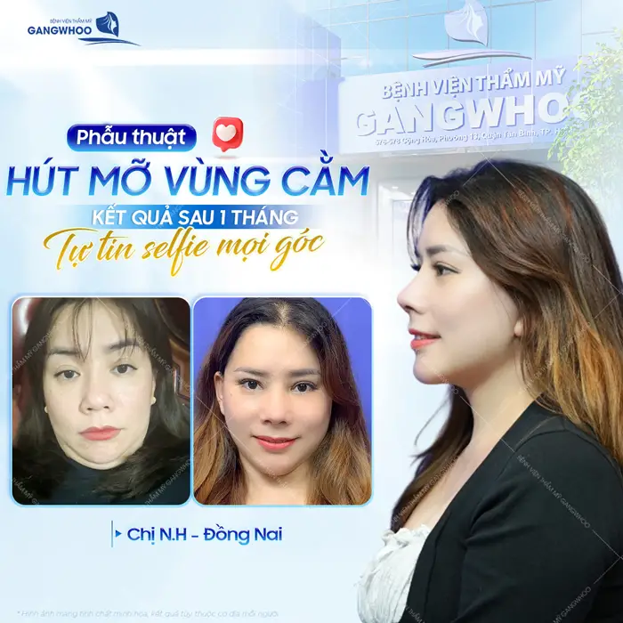 Phẫu thuật hút mỡ vùng cằm kết quả sau 1 tháng tự tin hơn với sự thay đổi của chính mình