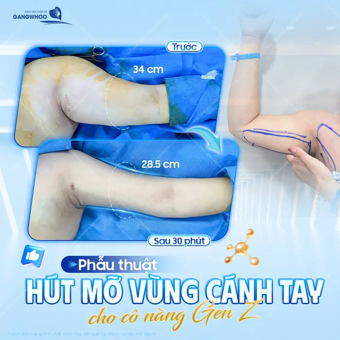Phẫu thuật hút mỡ vùng cánh tay cho cô nàng GenZ sau 30 đã thấy kết quả thay đổi đầy khác biệt 