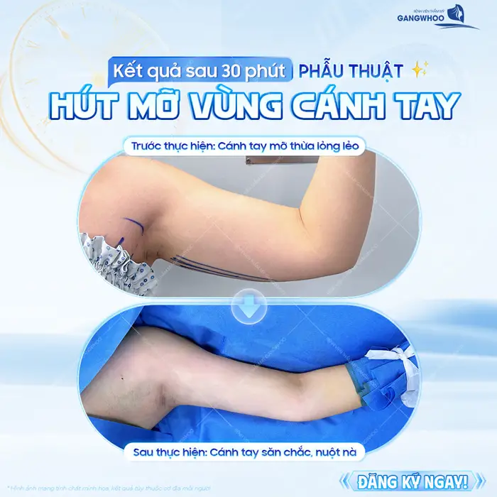 Kết quả sau 30 phút phẫu thuật hút mỡ vùng cánh tay giải quyết mỡ thừa hiệu quả và triệt để nhẹ nhàng không sưng đau