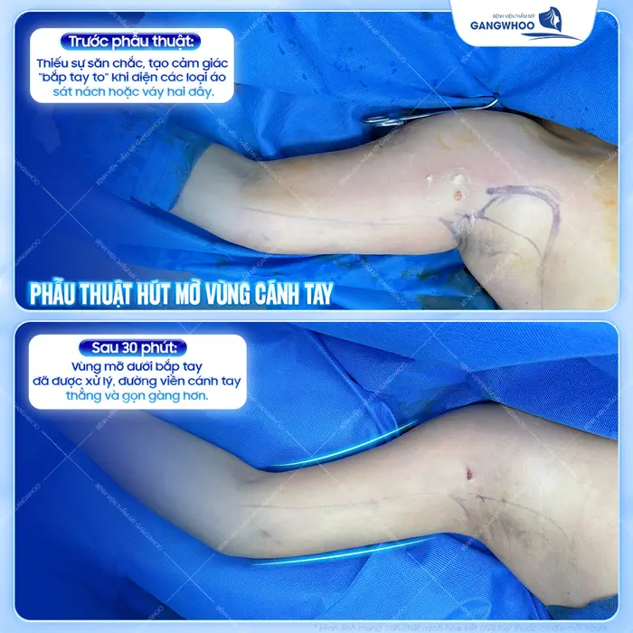 Phẫu thuật hút mỡ vùng cánh tay sau 30 phút đoi tay đã có sự thay đổi tích cực đầy mong đợi 