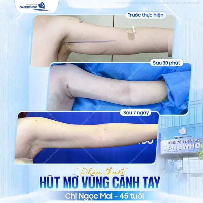 Phẫu thuật hút mỡ vùng cánh tay sau 7 ngày đã đẹp thon gọn và săn chắc đẹp thấy rõ