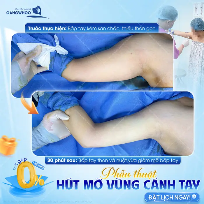 Phẫu thuật hút mỡ vùng cánh tay sau 30 phút tự tin khoe đôi tay đẹp thon gọn 
